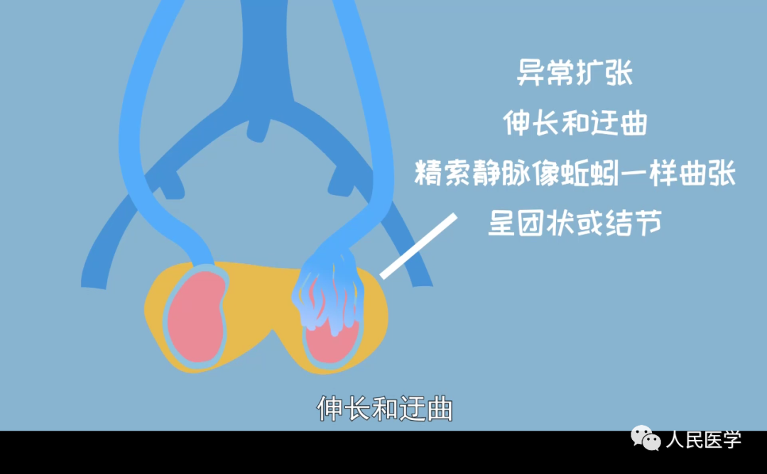 发病率15%,男青年注意,用香蕉告诉你精索静脉曲张