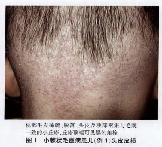 这种"黑头"因为有了毛,从此失去了黑头的资格.这种毛病经常被忽视.