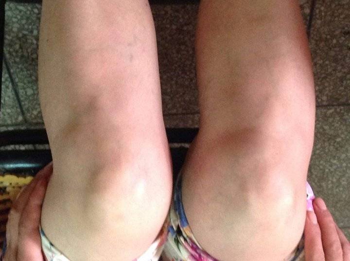 膝盖肿胀葱须加白醋消积液轻松赶走滑膜炎