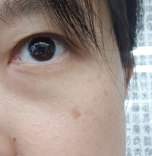 很多宝宝因夏天防晒工作做得不够好,脸颊很容易产生晒斑