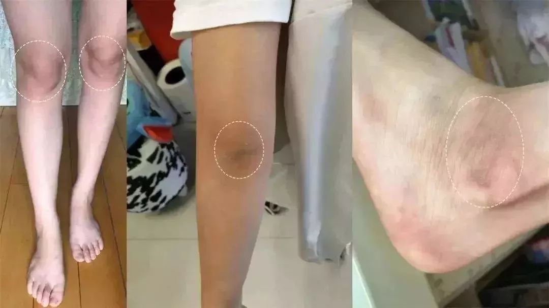 男朋友鸡皮肤穿裙子夏季(鸡皮肤的女生都怎么穿的裙子啊)