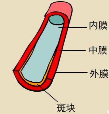 颈动脉内膜 中膜紧密相连,一般1.5mm,称为颈动脉斑块.