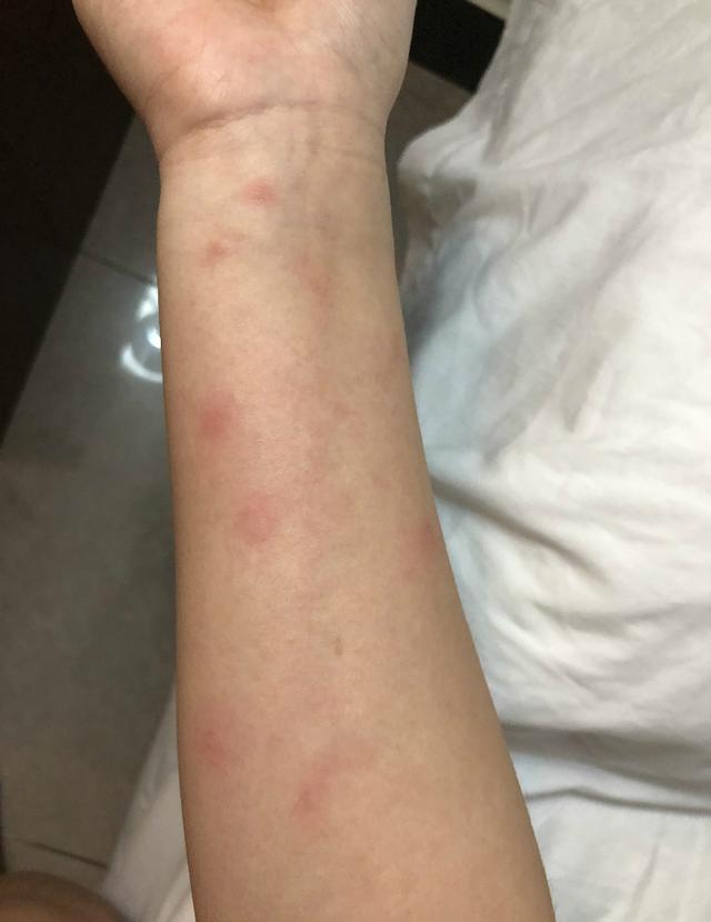 因为l同学对灰尘过敏,在进入该房间不到一小时后,胳膊开始起红包.