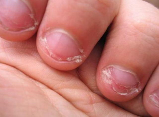 从小"咬指甲"的孩子,长大后怎么样了?专家:无非2种结果