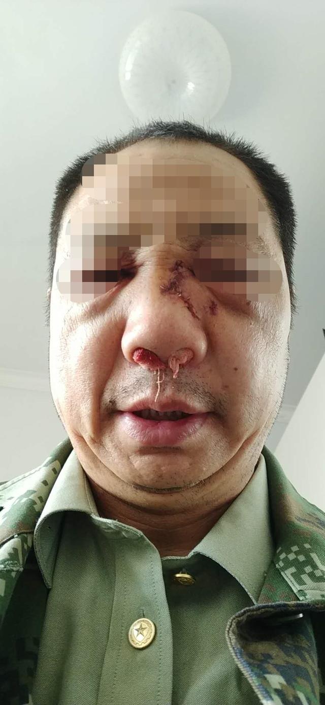 为建材公司工作时发生工伤致面部多处骨折,记者介入,最终协商补偿
