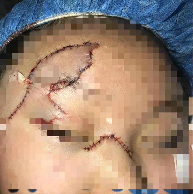 金属器械厂房里打乒乓球 9岁女孩被不锈钢板削伤半张脸