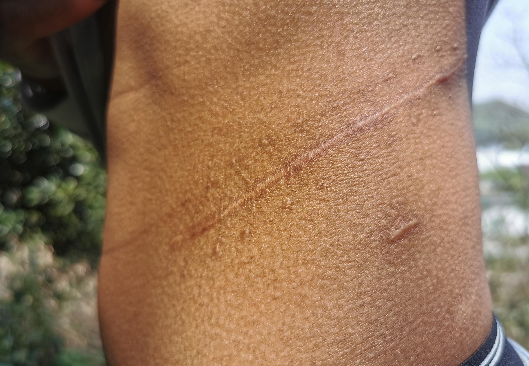 进行了肾脏摘除手术后,李瑞身上留下了一条长约20厘米的刀痕.