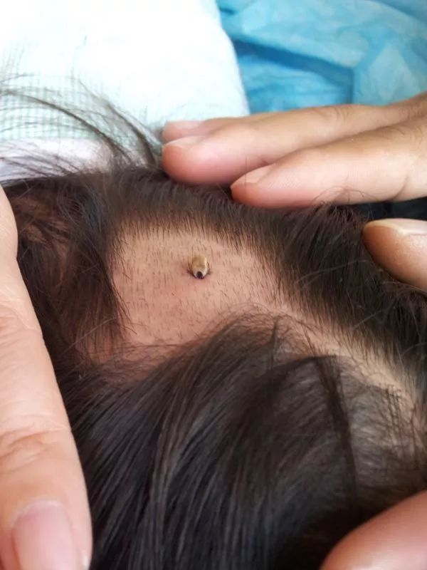 已多人被咬!被这种虫子咬伤严重可致命!