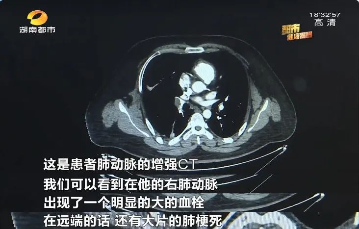 连续五天熬夜玩游戏,大三男生咳出血!这种问题久坐的人最容易有!