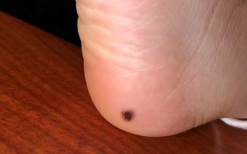 可怕知名医生痛心疾首提醒上万网友满身找痣