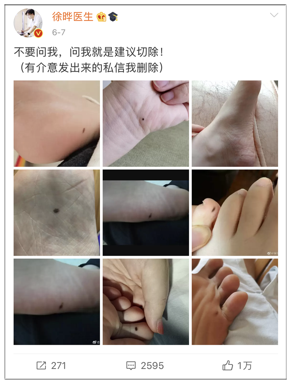 这几天上万网友在身上找痣!长在这些地方的都要切除