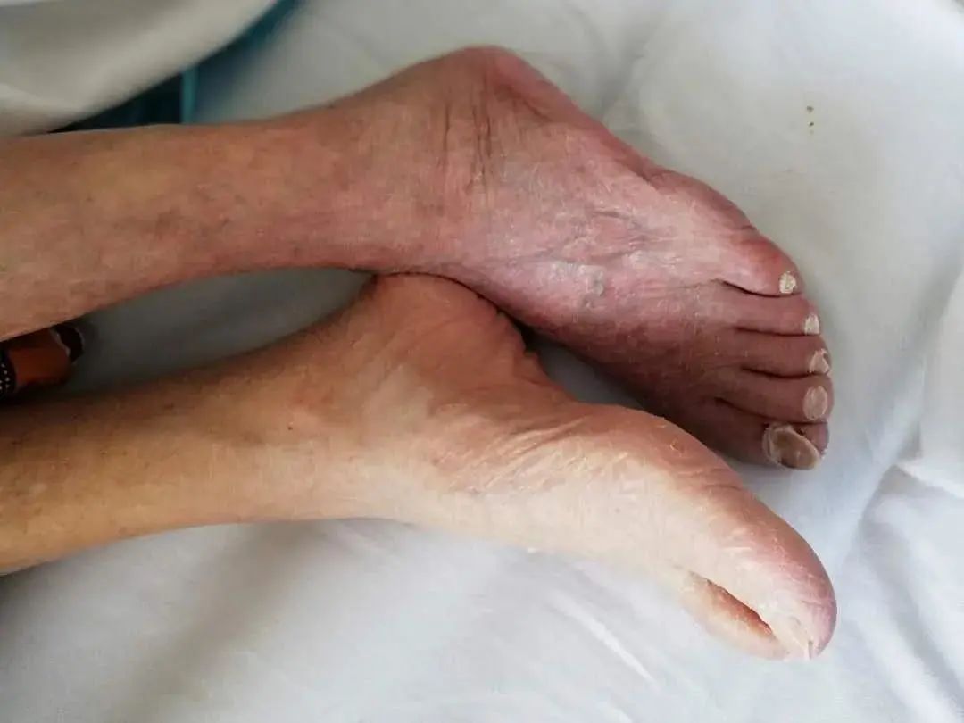 医生头条 | 下肢突然发凉,发绀警惕是急性动脉血栓惹的祸!