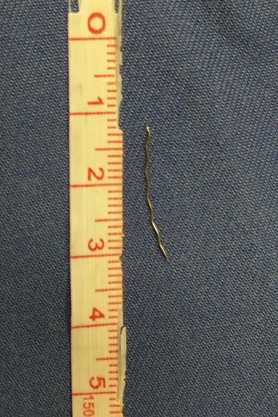 女子咽痛以为误吞鱼骨 元凶是2厘米长的细铁丝!|误吞|异物_新浪新闻