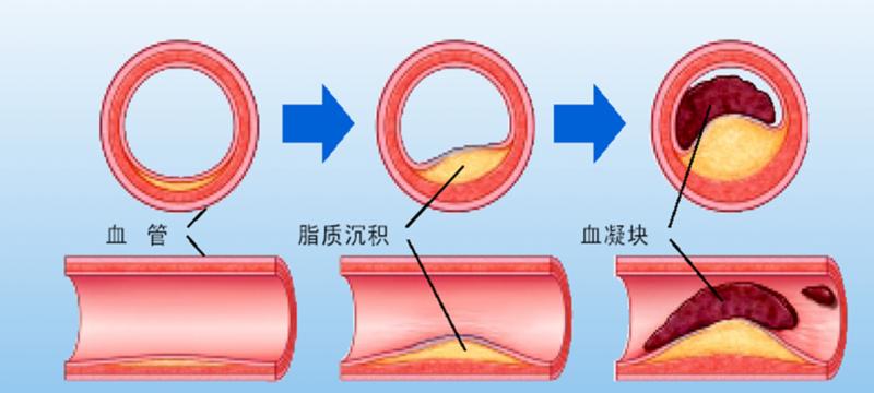 是指各种原因所致脑部血液供应障碍,导致脑组织缺血,缺氧性坏死,出现