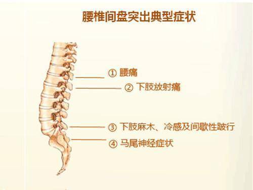 你在治療中有走入誤區了嗎|腰腿痛|腰腿疼_新浪新聞