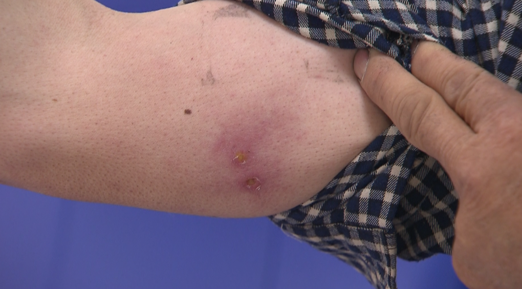 嫩江男子上山采野菜,三天后浑身无力,高烧39℃!近期高发,严重可致命!