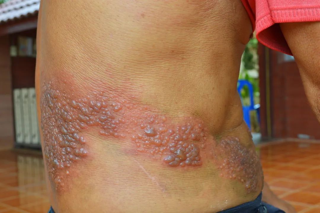 嗷嗷待哺的娃 腰疼难忍的妈,萌新中年人的硬抗实录|带状疱疹|皮肤科