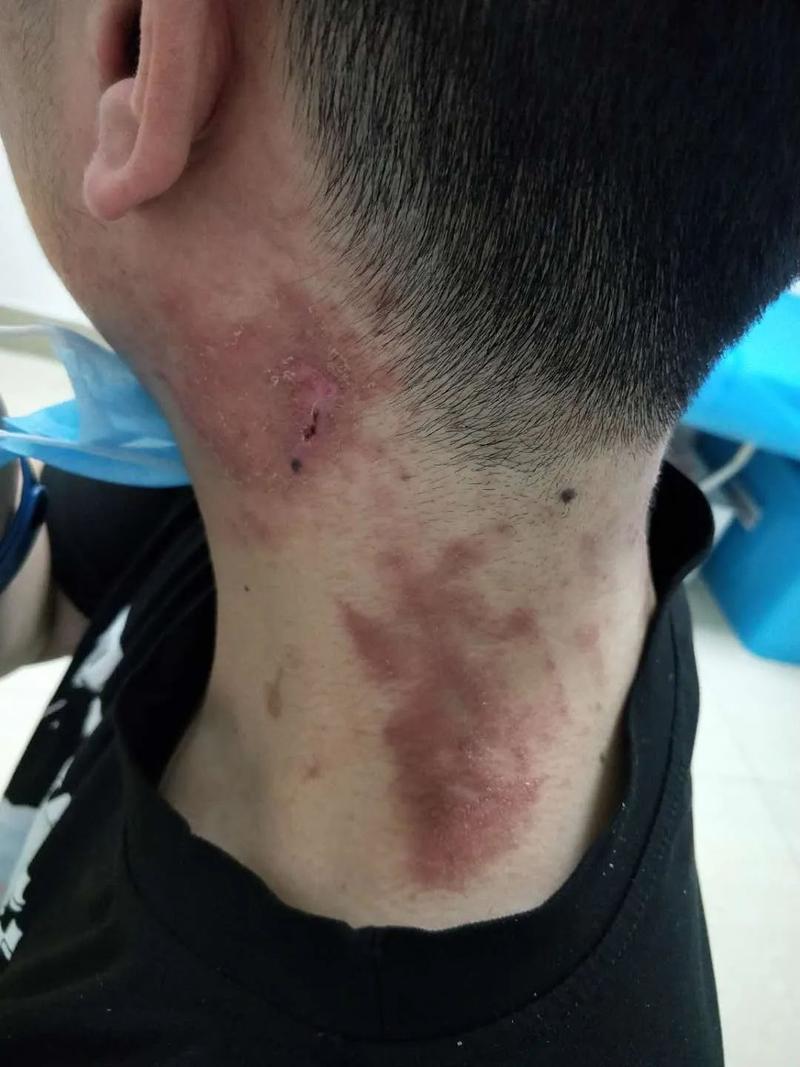 小伙随手捏死一只虫,一觉醒来满脸脓包!这些虫不能拍,严重可致命!