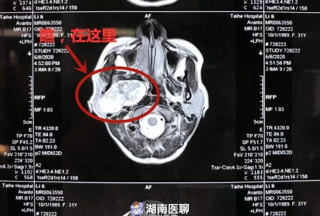 女子耳后鼓了一个包,不痛也不痒,检查一看竟是肿瘤"在惹祸"