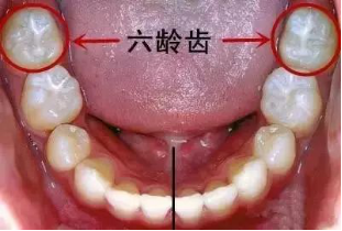 由于六龄牙的形态和位置特殊,相比乳牙来说,更容易蛀牙.