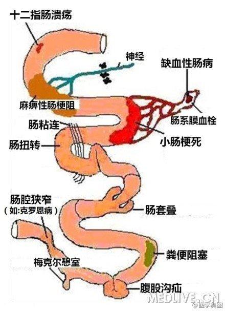 小肠出血与非特异性小肠溃疡|疾病|肠穿孔|消化道出血_新浪新闻