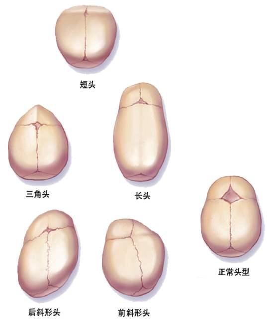 狭颅症(craniostenosis)的诊治|颅骨|手术_新浪新闻
