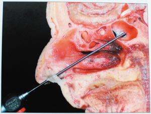 内镜,神经导航经蝶技术切除蝶窦病变|导航|垂体瘤|手术_新浪新闻