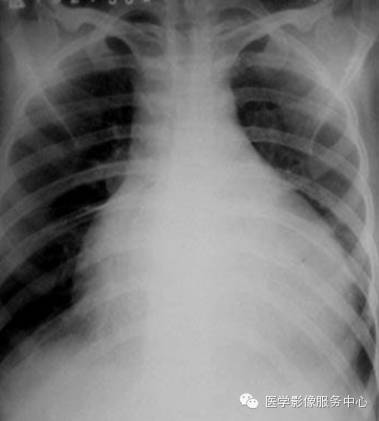 x线检查对少量的心包积液的诊断有限度.