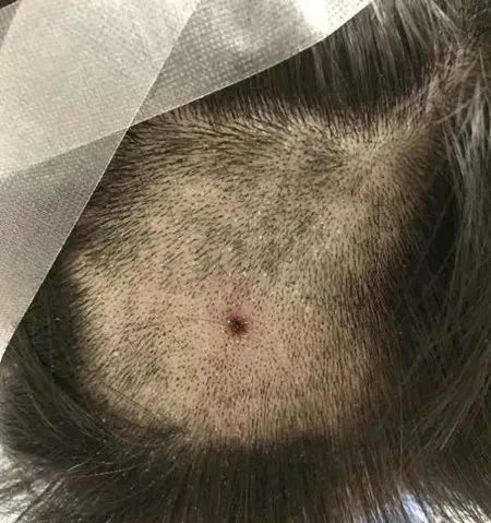 蜱虫在吸血时,它的头部包括口器是深深扎进皮肤里的,如果生拉硬拽,很