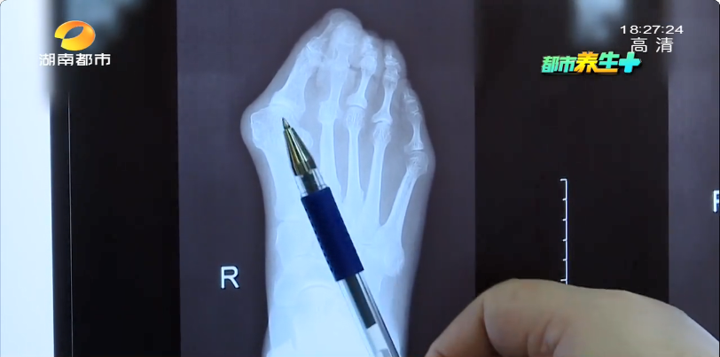 长沙一女士双脚脚掌变形一碰就疼竟是因为爱美惹的祸