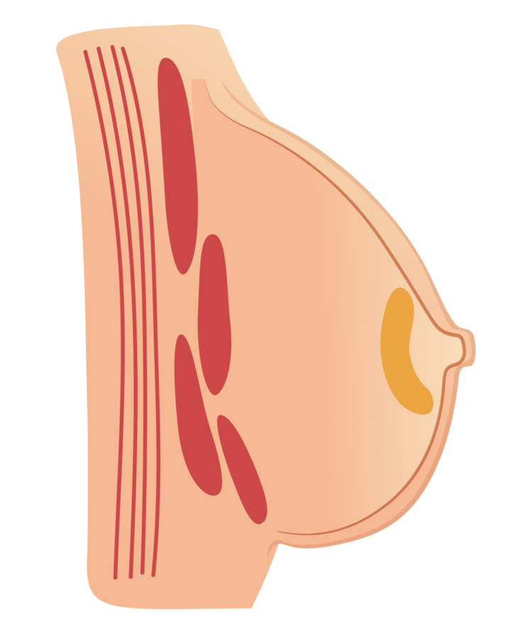体检查出『乳腺小叶增生』,会发展为乳腺癌吗?别一错再错了