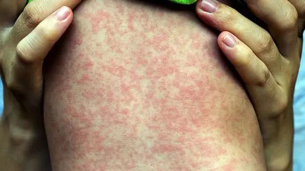 麻疹最早起源竟比预计早1400年!