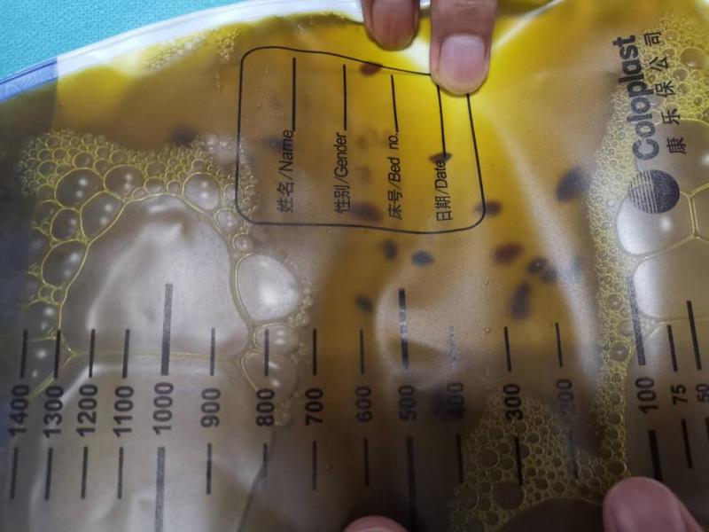 64岁阿伯腹痛黄疸,胆汁里竟窜出虫子