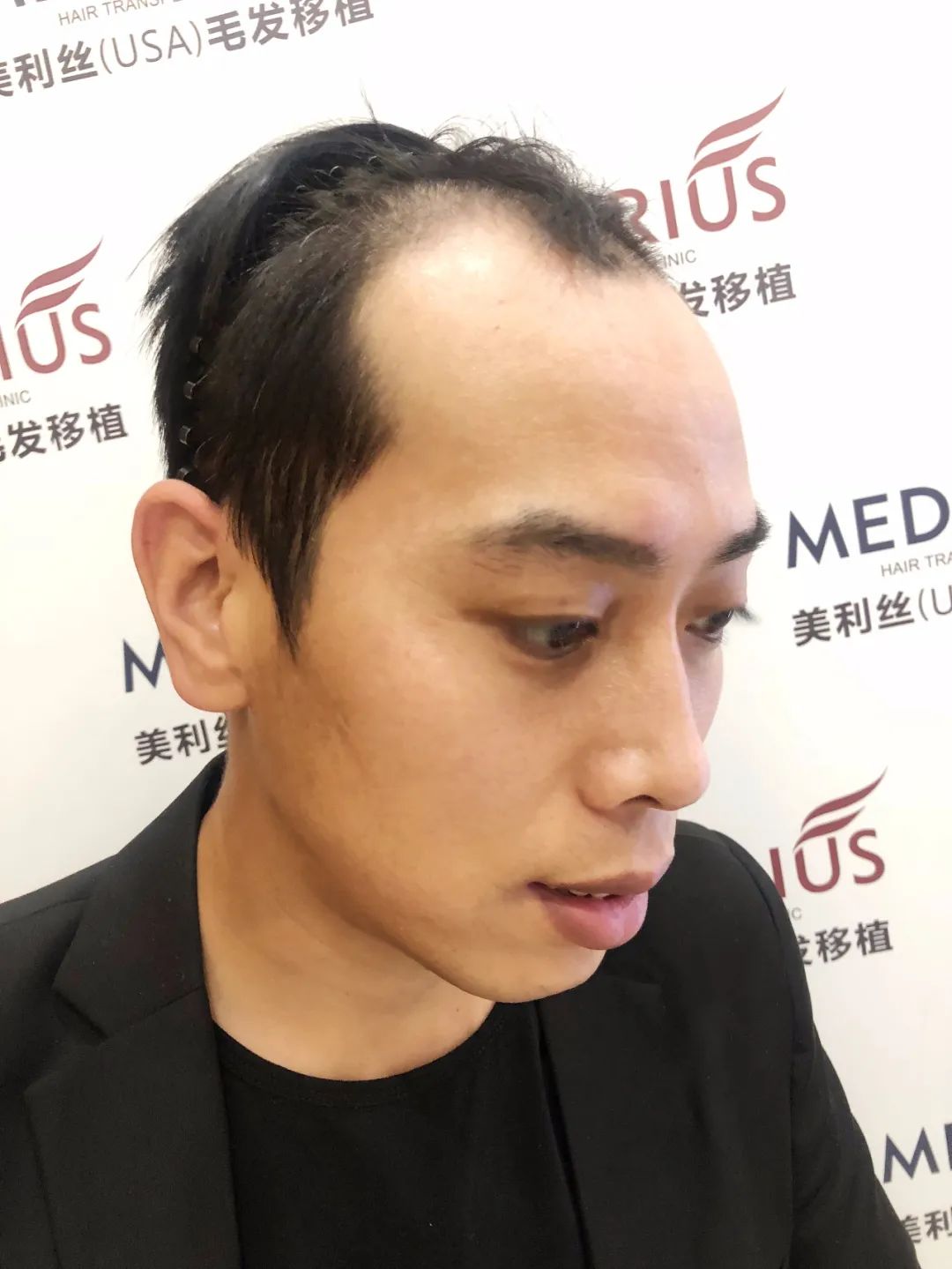 牙签造型,疯狂烫发失败,80后男子脱发4年后用4小时,"长"了真头发!