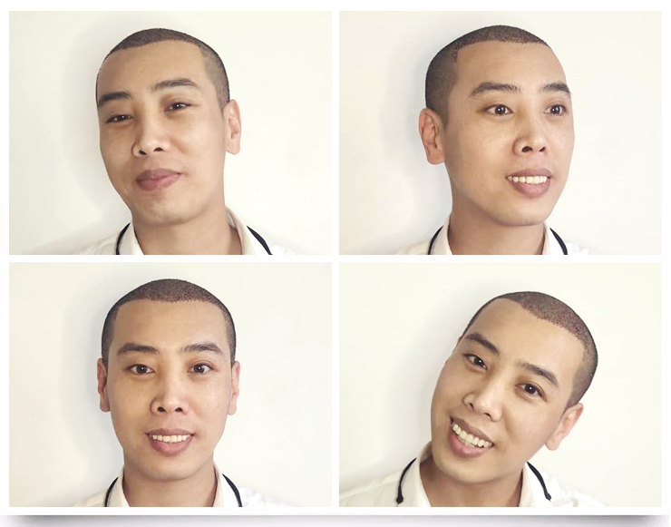 牙签造型,疯狂烫发失败,80后男子脱发4年后用4小时,"长"了真头发!