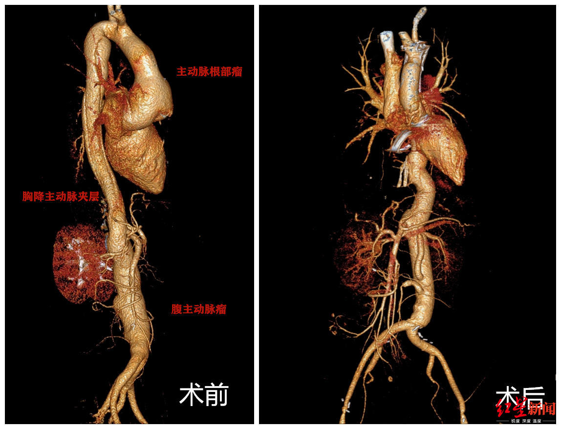四川這臺首例手術真牛!8小時將女子整根主動脈換成人工血管