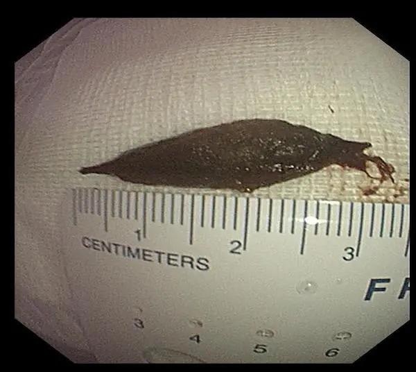 百岁老人吃粽子误吞枣核，东方医院医生2分钟完成取出手术！休闲区蓝鸢梦想 - Www.slyday.coM