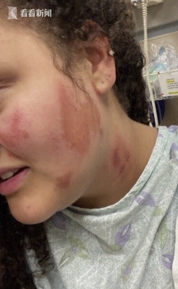 混血女生开车遭纵火 等红灯时被扔打火机脸部烧伤
