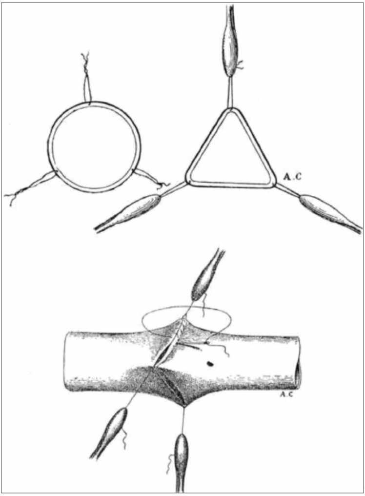 用三根等距离的牵引线固定,将圆口变为三角形,然后再全层缝合
