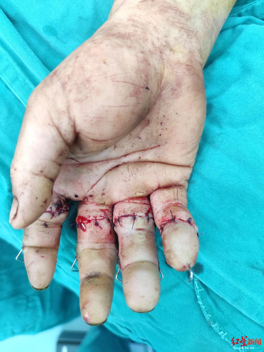 4指被切断医生用01毫米线缝合血管历时10小时完成断指再植