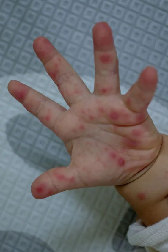 手足口病是一种症候群,顾名思义,其主要特征是在手,足,口,臀部出现