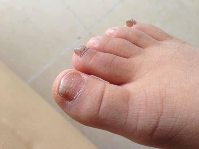 指甲颜色出现改变:如果你没有月牙,指甲颜色还变化明显的话,不再是