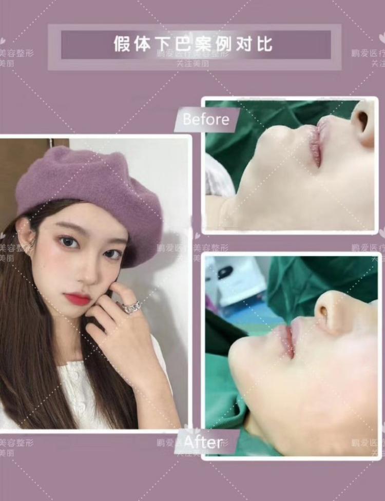 假体下巴术后即刻