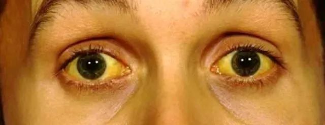 nla hers05ey如果是均匀发黄且黄得厉害,就是常说的「巩膜黄染」,这