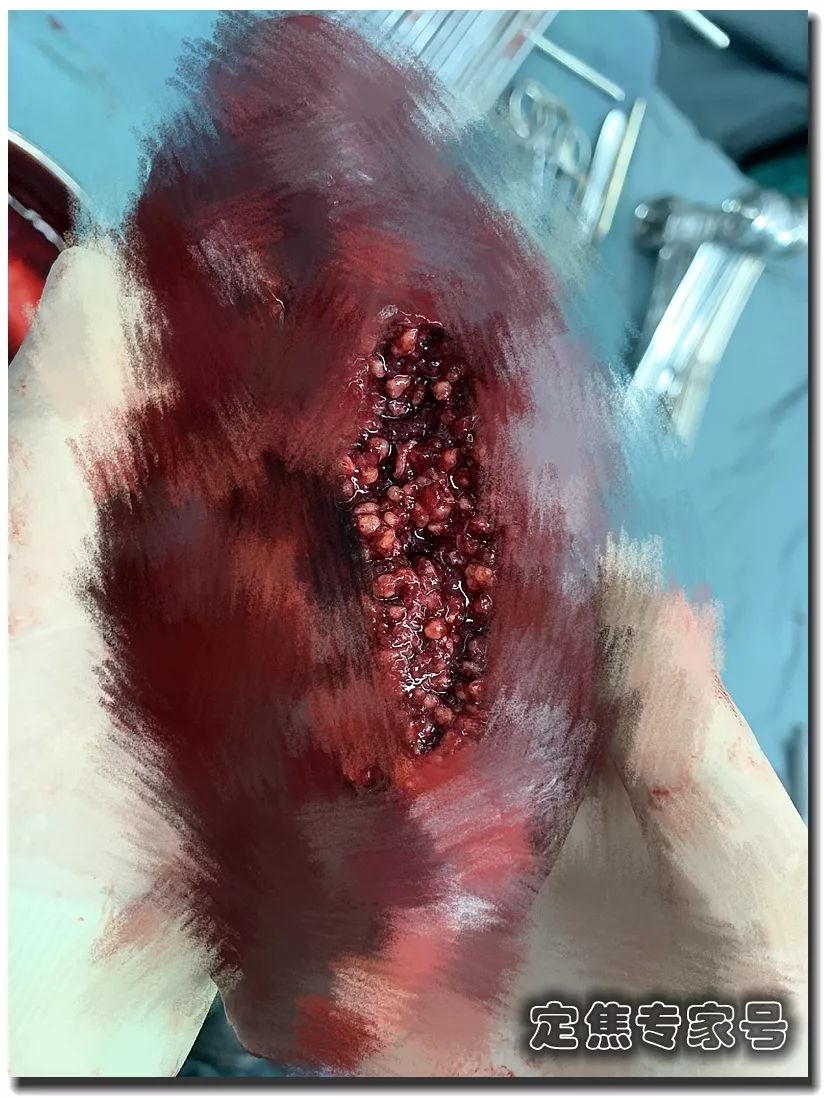 姑娘脾脏长满密密麻麻的虫卵,这个吃饭习惯害惨她!