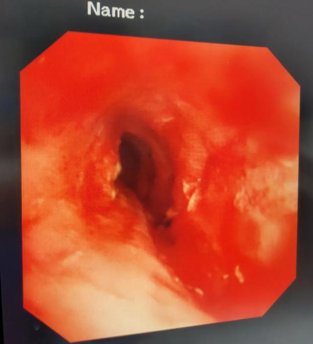 鱼刺卡喉求千万不要试图用饭团、馒头把鱼刺吞进去休闲区蓝鸢梦想 - Www.slyday.coM