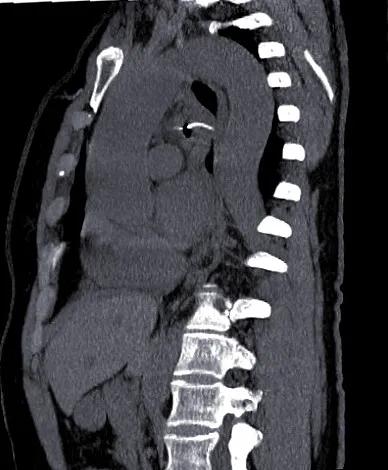 鱼刺卡喉求千万不要试图用饭团、馒头把鱼刺吞进去休闲区蓝鸢梦想 - Www.slyday.coM