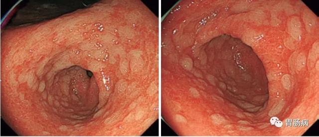 慢性萎缩性胃炎c2图片