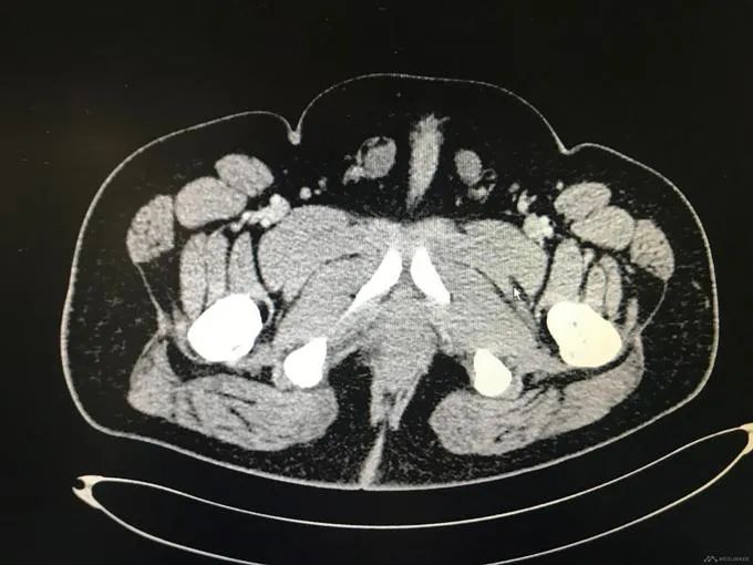 小刘的染色体核型为46xy,即男性,ct,b超都未能找到子宫和卵巢,反而
