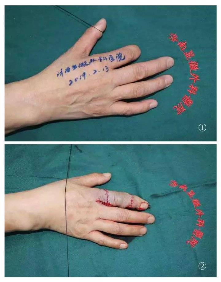 走向国际化,60岁匈牙利华侨3d全形手指再造成功!